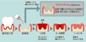 通常のソケットとの比較